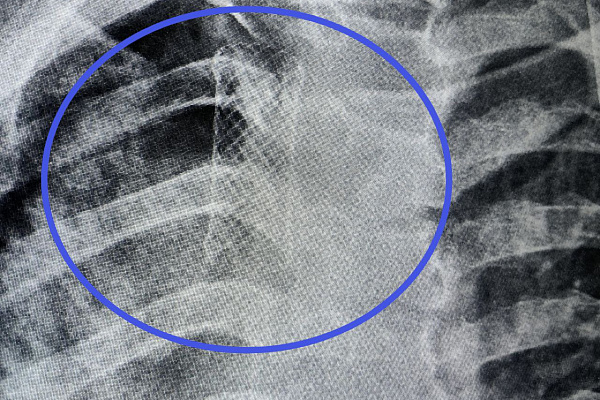 Торакальные хирурги Сургутской травмбольницы впервые столкнулись с послеоперационной перфорацией трахеи