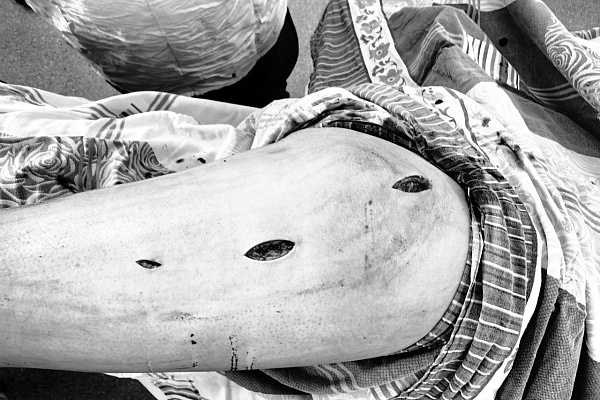 Два инсульта, и оба - с переломами. В Сургутской травматологической больнице повторно ставят на ноги 55-летнего мужчину 