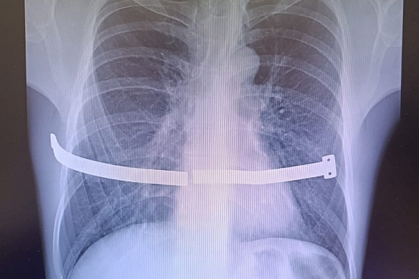 В миллиметрах от сердца. К повреждению внутренних органов едва не привела беспечность пациента, затянувшего с операцией