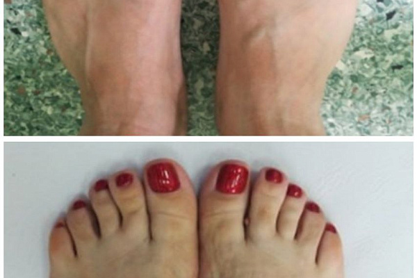 Красота требует, мы исполняем. Наращиваем объёмы высокотехнологичных реконструктивных операций при Hallux Valgus