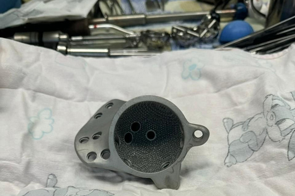 В Сургутской травмбольнице впервые установили 3D-эндопротез, изготовленный по индивидуальным параметрам пациента