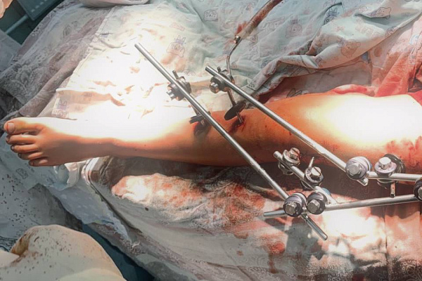 Едва не остался без ноги на карусели. 6-летнего пациента совместно спасали врачи Сургутской травмбольницы и СОКБ