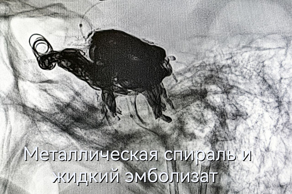Разрыв сонной артерии от удара футбольным мячом. Рентгенохирурги травмбольницы спасли пациента с опасным повреждением сосудов головного мозга