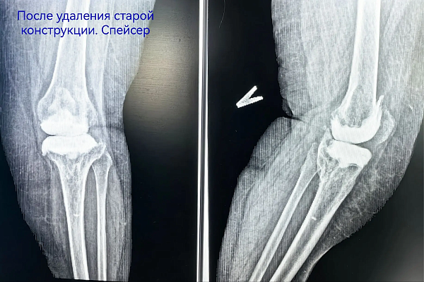 В Сургутской травмбольнице впервые выполнили эндопротезирование коленного сустава с установкой 3D-импланта