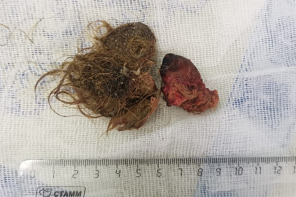 В Сургутской травмбольнице впервые оперировали редкую опухоль головного мозга – тератому