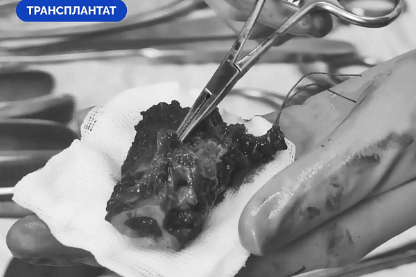 Сургутские травматологи-ортопеды восстановили бойцу СВО локтевую кость с помощью трансплантата на сосудистой ножке