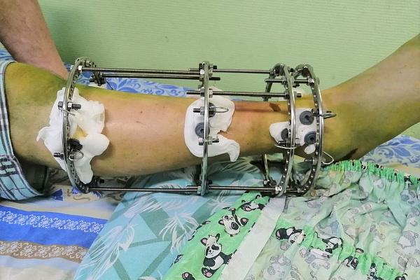 При участии пациентов и медперсонала травмбольницы сургутские волонтёры разрабатывают одежду для военных госпиталей