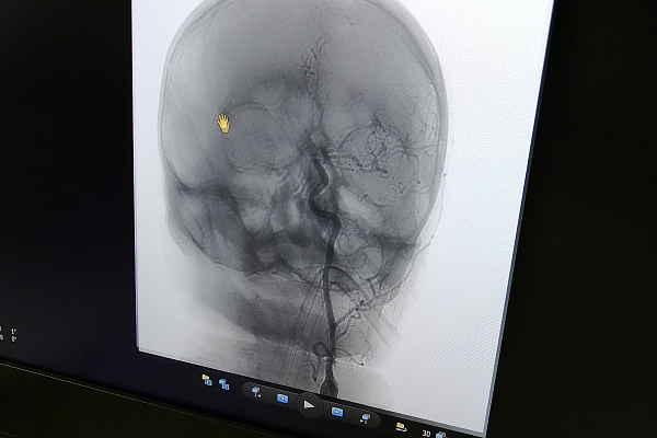 Редкий случай, тонкая работа. Рентгенохирургам травмбольницы пришлось одновременно стентировать сонную артерию и эмболизировать аневризму пожилому пациенту 