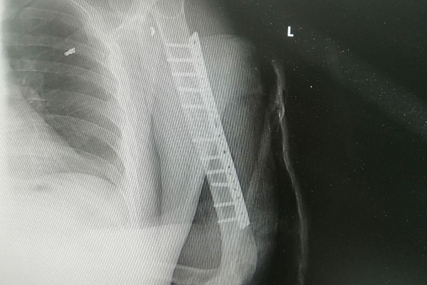 Пересадили нерв из ноги в плечо. Сургутские травматологи-ортопеды выполнили сложную микрохирургическую операцию пациенту с минно-взрывным ранением