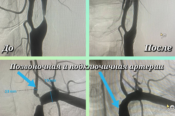 При нагрузке на руку страдал головной мозг. Пациенту с синдромом обкрадывания выполнили стентирование сразу трёх крупных артерий