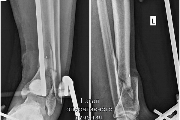 Строил баню – едва не остался инвалидом. В Сургутской травмбольнице экстренно спасали ногу мужчине, поранившемуся болгаркой