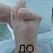 Микрохирурги Травматологической больницы Сургута выполняют более 150 операций при деформации переднего, среднего и заднего отделов стопы