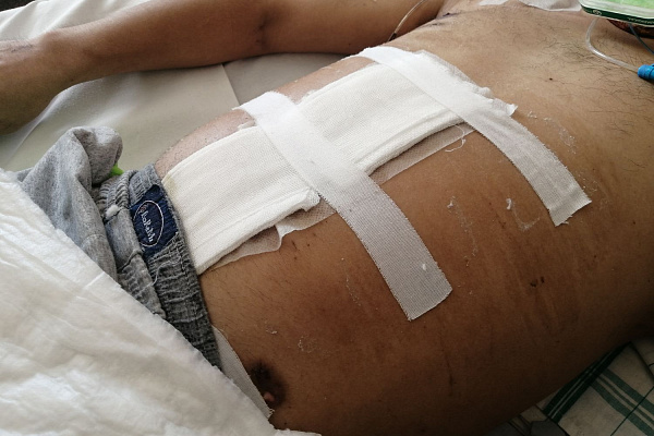 Борьбу за жизнь пострадавшего в ДТП пациента хирургам травмбольницы помогла выиграть VAK-терапия. Когда и как применяется этот метод лечения ран? 