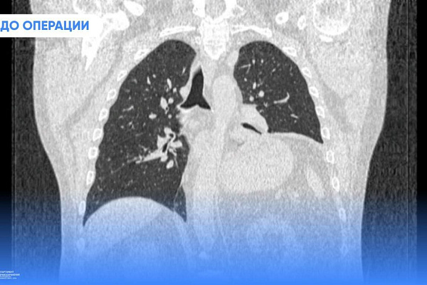 Редкий диагноз, редкая операция. Торакальные хирурги Сургутской травмбольницы выполнили пластику диафрагмы 64-летнему пациенту 