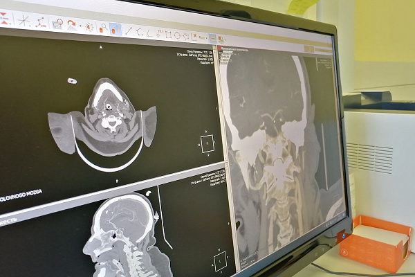 Зашла в магазин – очнулась в реанимации. Сургутской пенсионерке удалось избежать тяжелейших последствий тромбоэмболии основной артерии головного мозга