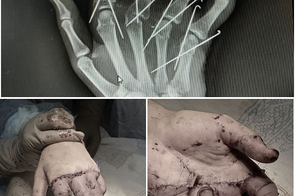 Пациенту Сургутской травмбольницы восстановили кисть после полной травматической ампутации целого сегмента с четырьмя пальцами