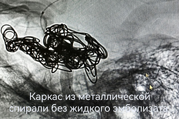 Разрыв сонной артерии от удара футбольным мячом. Рентгенохирурги травмбольницы спасли пациента с опасным повреждением сосудов головного мозга