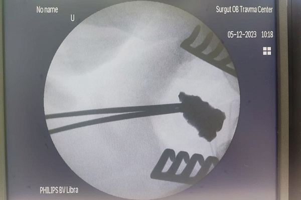 Хирурги Сургутской травмбольницы и Сургутской окружной клинической больницы совместно удалили осколок снаряда участнику СВО
