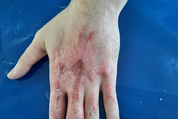 Зачем пациенту Сургутской травмбольницы пришили руку к животу? На что ещё идут хирурги, чтобы восстановить целостность кожного покрова на повреждённых участках