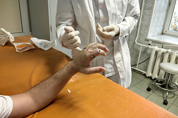 Пациенту Сургутской травмбольницы восстановили кисть после полной травматической ампутации целого сегмента с четырьмя пальцами