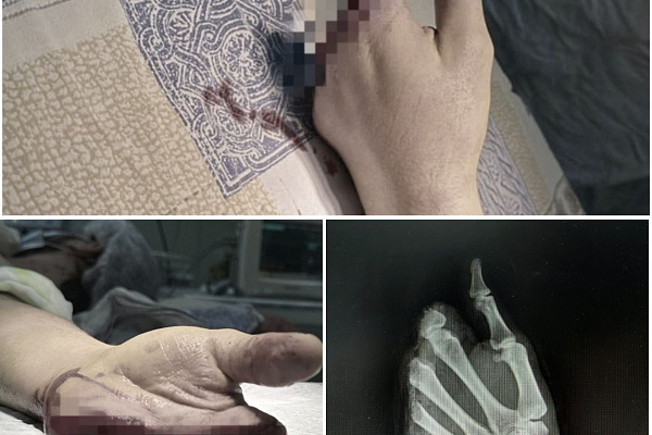 Пациенту Сургутской травмбольницы восстановили кисть после полной травматической ампутации целого сегмента с четырьмя пальцами