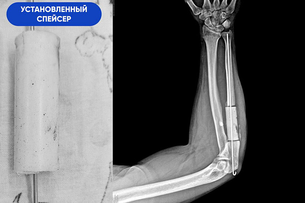 В Сургутской травмбольнице бойцу СВО пересадили фрагмент кости из голени в предплечье, чтобы спасти руку после ранения 