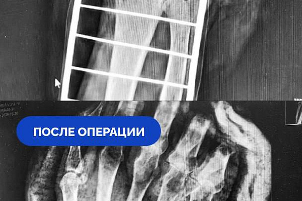 Держалась на одном кожном лоскуте. В Сургутской травмбольнице успешно выполнили реплантацию кисти после травматической ампутации
