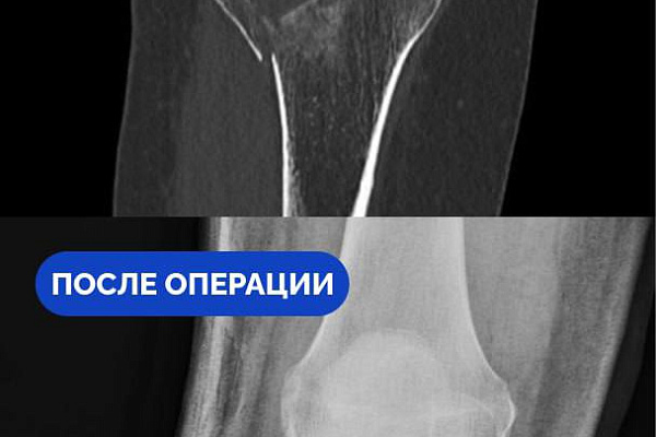 В Сургутской травмбольнице спасли от инвалидности жительницу Самарской области, приехавшую в Югру работать по вахте