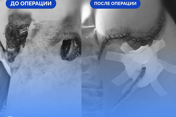 Пациента с тяжелой бытовой травмой области живота спасли в Сургутской травмбольнице