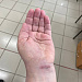 В Сургутской травмбольнице  начали выполнять уникальные для Югры малоинвазивные вмешательства при карпальном туннельном синдроме 