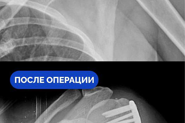 В Сургутской травмбольнице спасли от инвалидности жительницу Самарской области, приехавшую в Югру работать по вахте