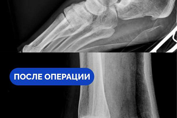 В Сургутской травмбольнице спасли от инвалидности жительницу Самарской области, приехавшую в Югру работать по вахте
