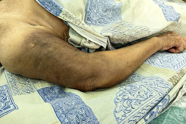 В Сургутской травмбольнице прооперировали 92-летнюю пациентку с тяжелым переломом